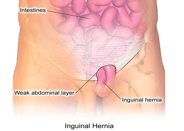 Inguinal hernia, Diagnosis, Treatment